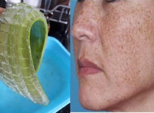 Cách trị nám và tàn nhang bằng nha đam hiệu quả “nhanh” tại nhà